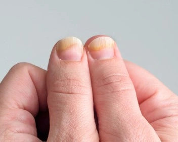Gula naglar: orsaker, symptom och behandlingar